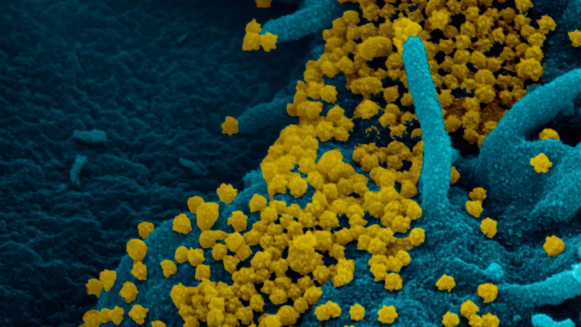 Изображение SARS-CoV-2, полученное с помощью сканирующей электронной микроскопии мазка из носоглотки пациентки с ослабленным иммунитетом - РИА Новости, 1920, 11.02.2021
