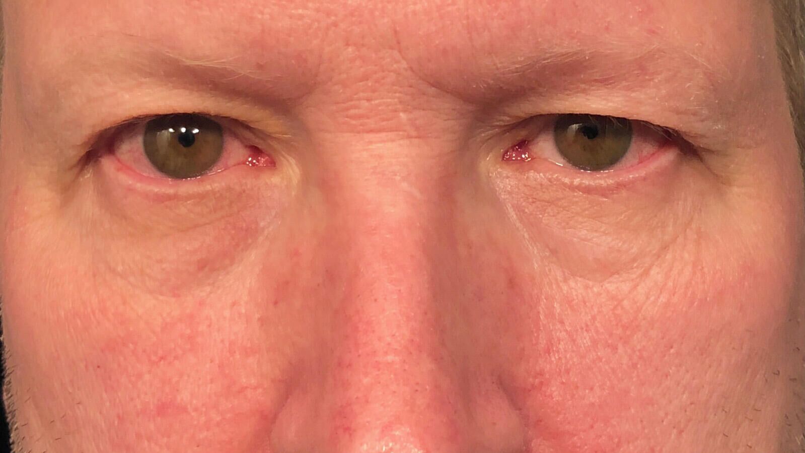 Вирусный конъюнктивит при COVID-19 - РИА Новости, 1920, 17.01.2022