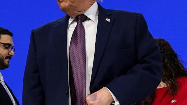 Трамп с кровоподтеком на руке