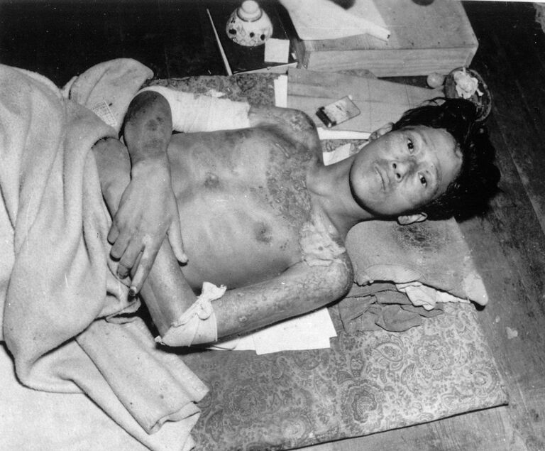 Молодой японец, пострадавший в результате атомной бомбардировки Нагасаки. Конец 1945 года