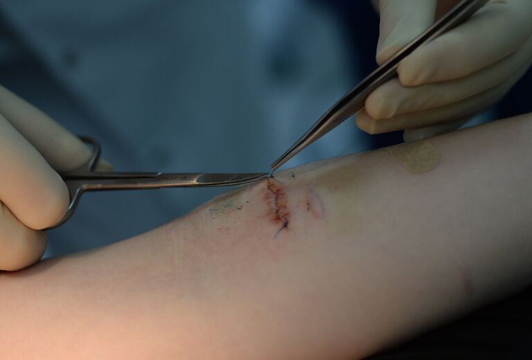 Зашивание раны