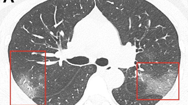 Изображение легких, пораженных коронавирусом