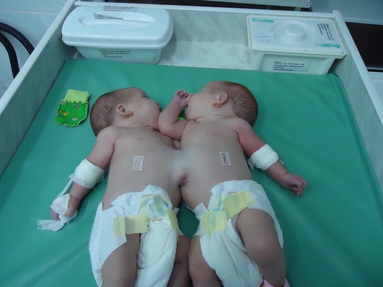 Операция по разделению сиамских близнецов в Барнауле